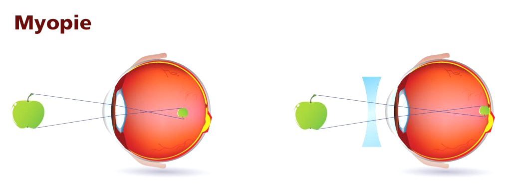 Myopie Erklärbild